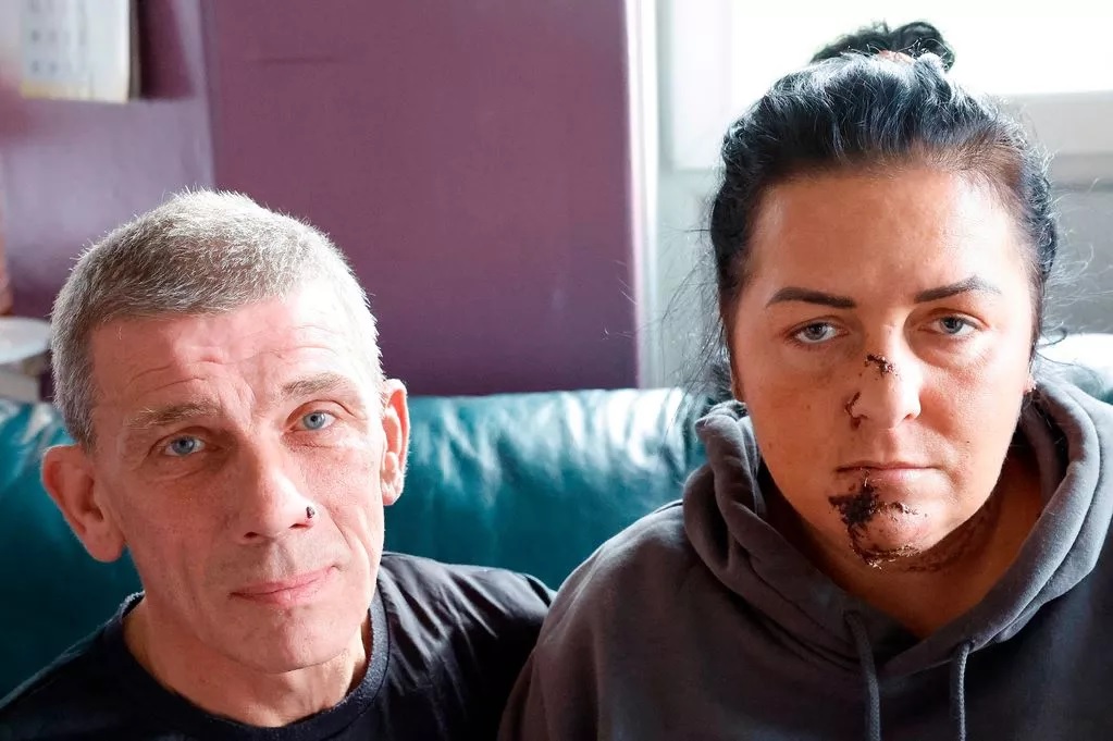 Anya és lánya életre szóló sebeket szerzett egy kutyatámadásban